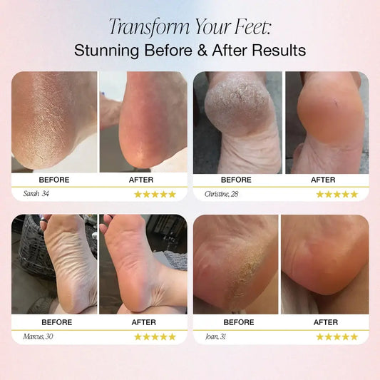 Electric Foot Callus Remover Foot grinding device