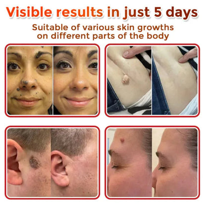Painless Skin Tag & Wart Removal Patches