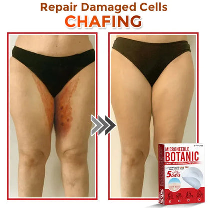 Painless Skin Tag & Wart Removal Patches